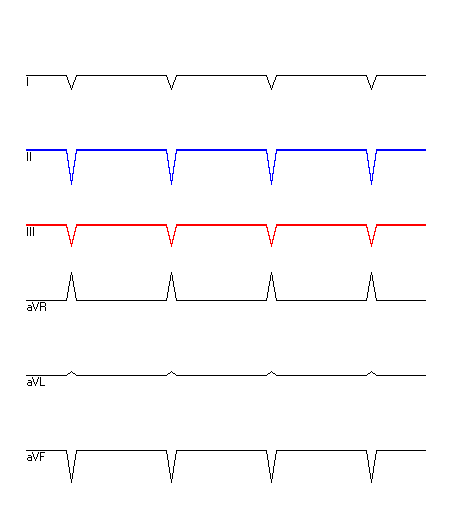 EKG mit hervorgehobenen Ableitungen