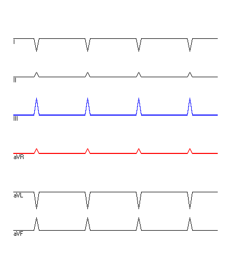 EKG mit hervorgehobenen Ableitungen