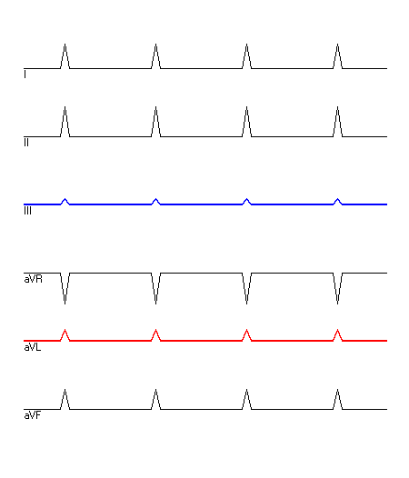 EKG mit hervorgehobenen Ableitungen