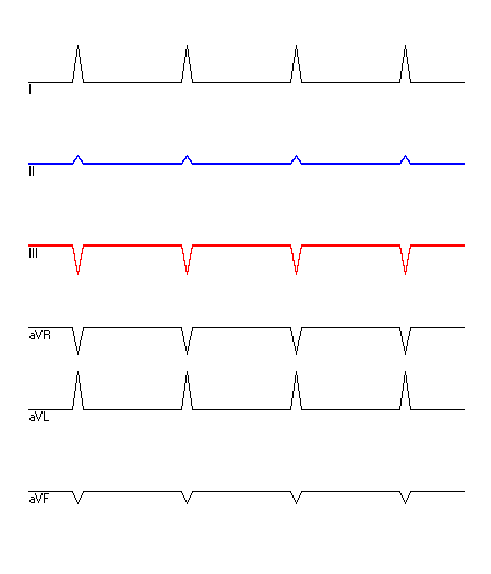 EKG mit hervorgehobenen Ableitungen