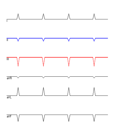 EKG mit hervorgehobenen Ableitungen