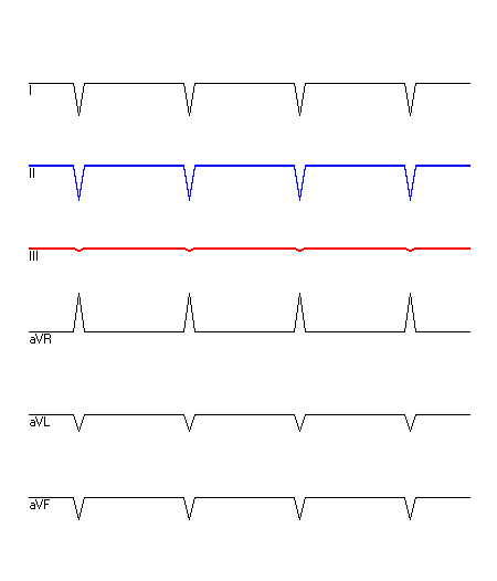 EKG mit hervorgehobenen Ableitungen