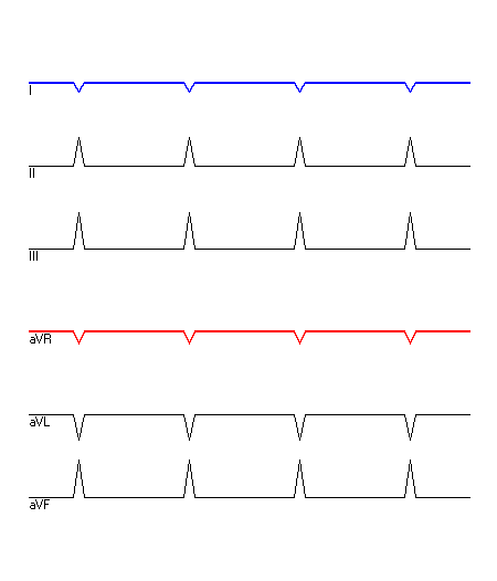 EKG mit hervorgehobenen Ableitungen