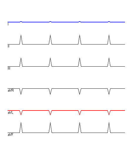 EKG mit hervorgehobenen Ableitungen