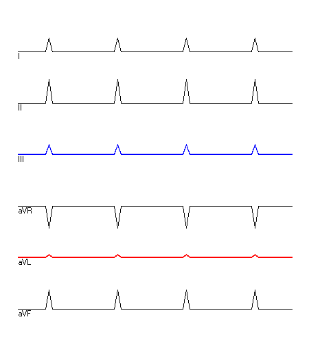 EKG mit hervorgehobenen Ableitungen