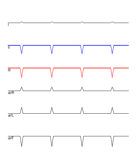 EKG mit hervorgehobenen Ableitungen