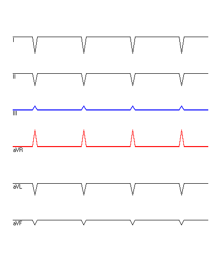 EKG mit hervorgehobenen Ableitungen