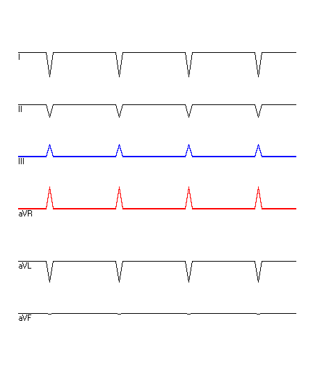 EKG mit hervorgehobenen Ableitungen