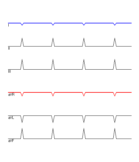 EKG mit hervorgehobenen Ableitungen