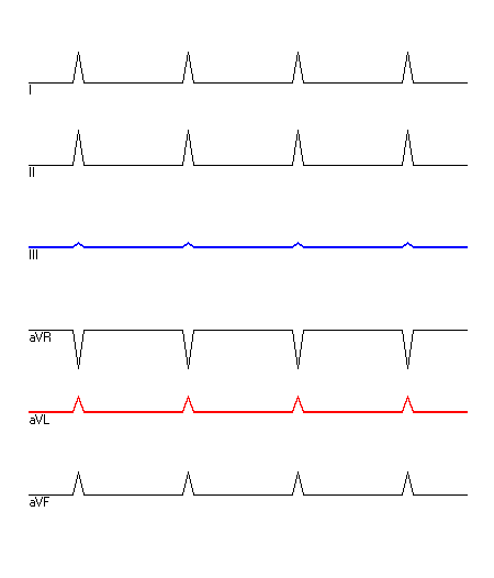 EKG mit hervorgehobenen Ableitungen