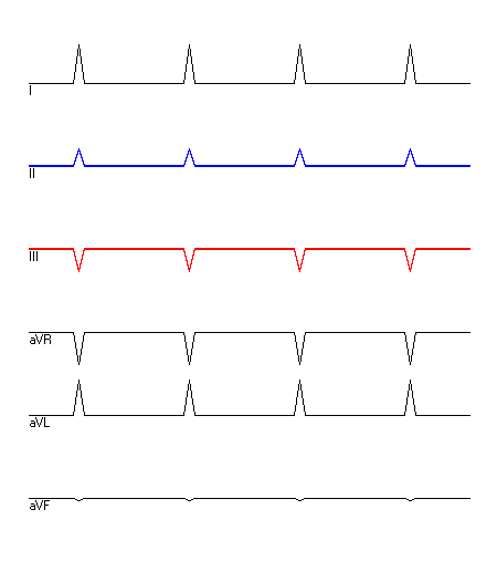 EKG mit hervorgehobenen Ableitungen