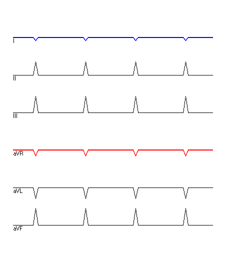 EKG mit hervorgehobenen Ableitungen