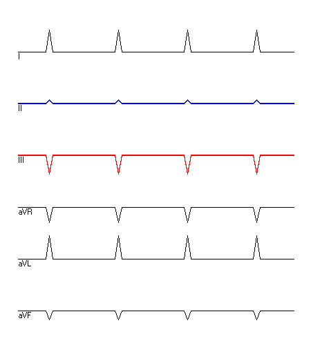 EKG mit hervorgehobenen Ableitungen