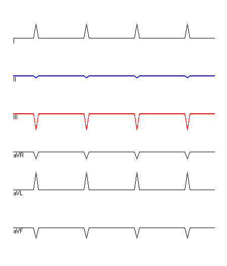 EKG mit hervorgehobenen Ableitungen