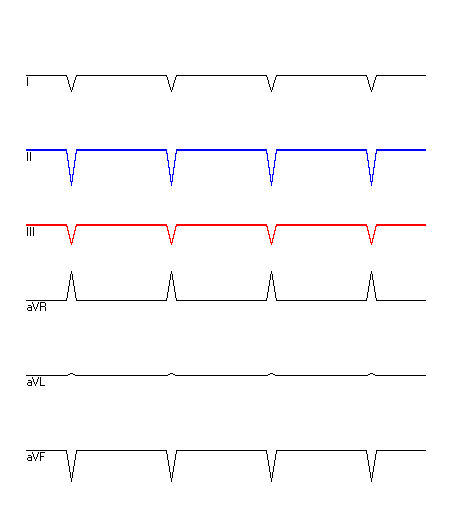 EKG mit hervorgehobenen Ableitungen