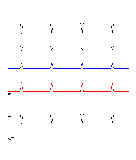 EKG mit hervorgehobenen Ableitungen