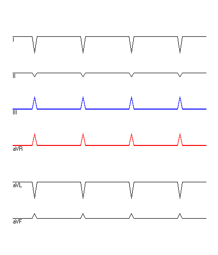 EKG mit hervorgehobenen Ableitungen