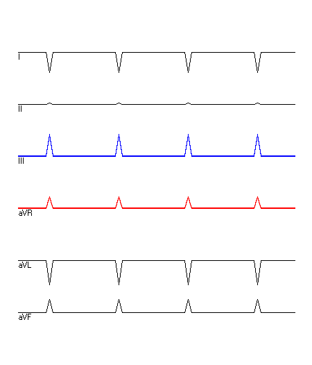 EKG mit hervorgehobenen Ableitungen