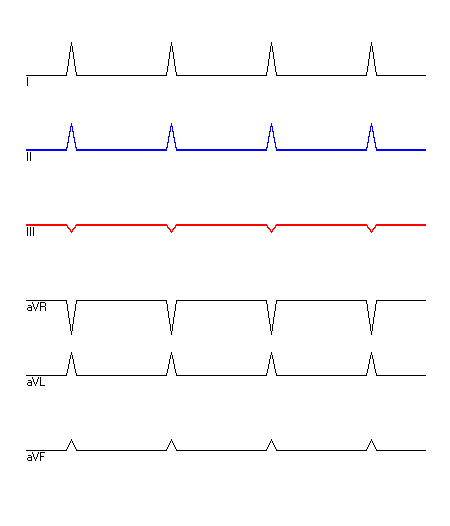 EKG mit hervorgehobenen Ableitungen