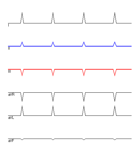 EKG mit hervorgehobenen Ableitungen