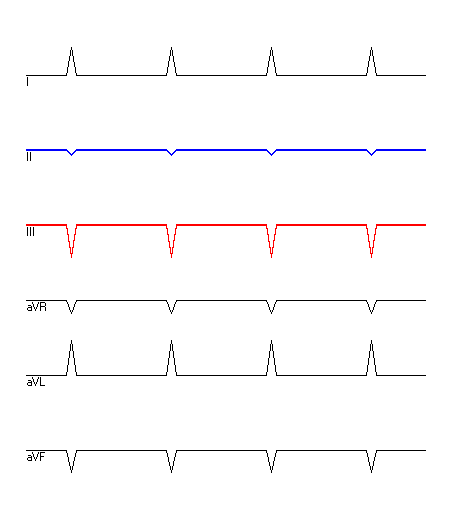 EKG mit hervorgehobenen Ableitungen