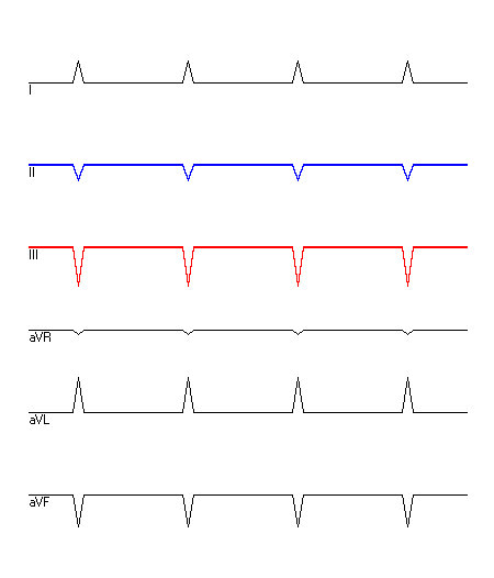 EKG mit hervorgehobenen Ableitungen