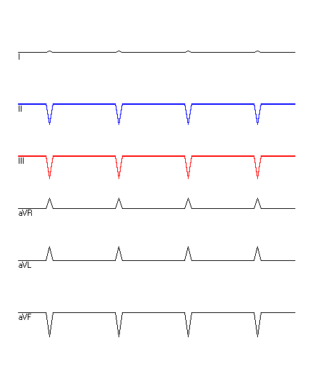 EKG mit hervorgehobenen Ableitungen