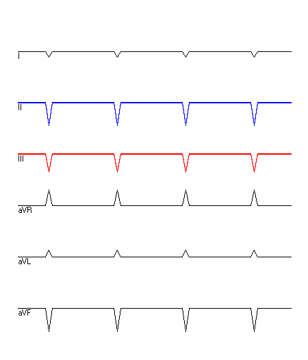 EKG mit hervorgehobenen Ableitungen