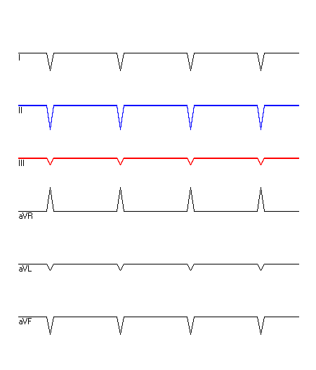 EKG mit hervorgehobenen Ableitungen