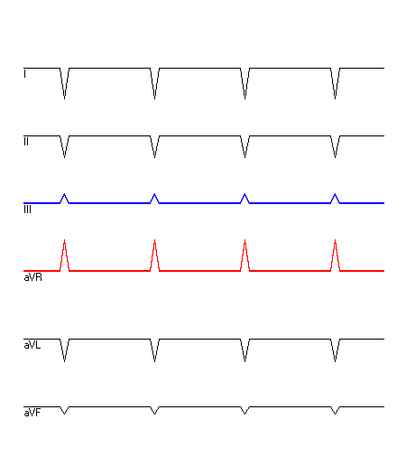 EKG mit hervorgehobenen Ableitungen