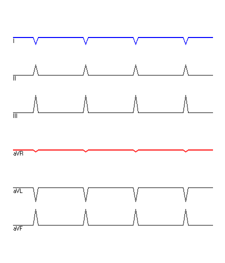 EKG mit hervorgehobenen Ableitungen