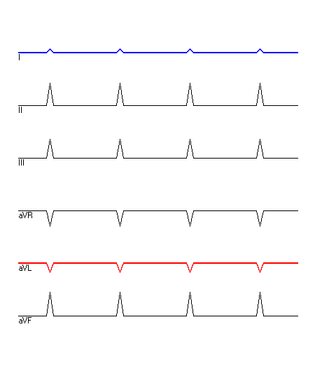 EKG mit hervorgehobenen Ableitungen