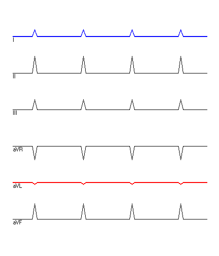 EKG mit hervorgehobenen Ableitungen