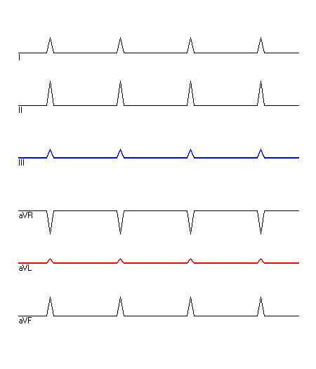 EKG mit hervorgehobenen Ableitungen