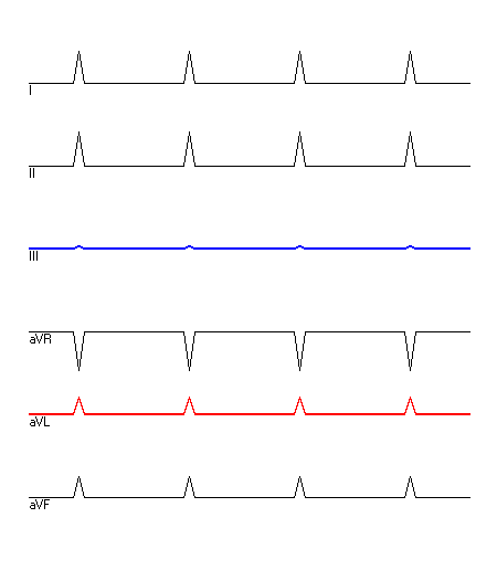 EKG mit hervorgehobenen Ableitungen